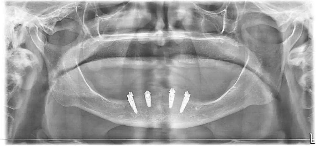 Panoramski rendgenski snimak bezube vilice s četiri implantata u donjoj vilici
