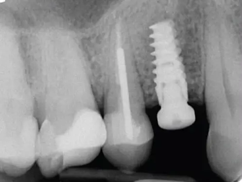 Rendgenski snimak jednog implantata pored zuba s plombiranim kanalom korijena i nadogradnjom
